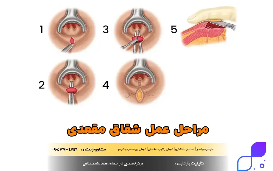 عکس بعد از عمل شقاق مقعدی