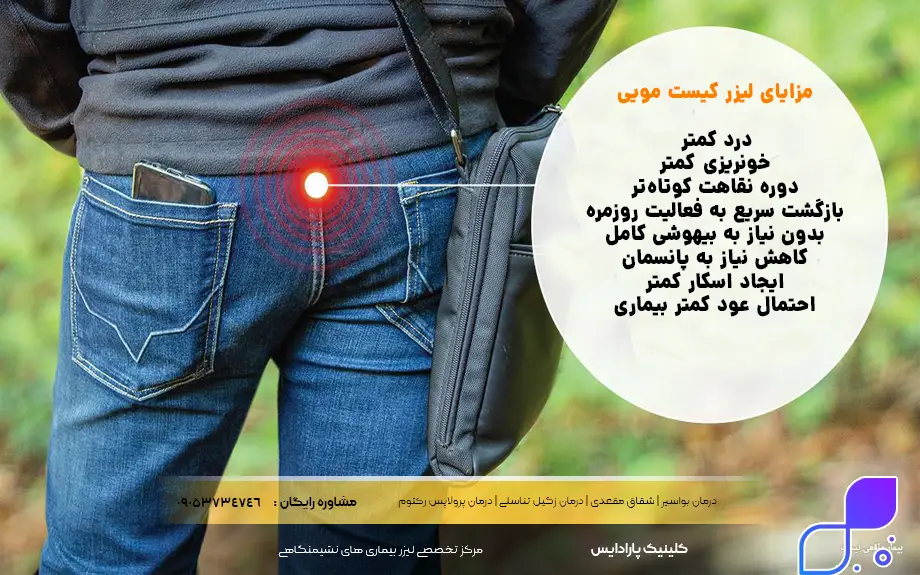 مزایای درمان کیست مویی با لیزر