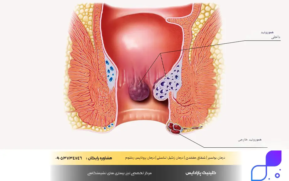 بیماری هموروئید