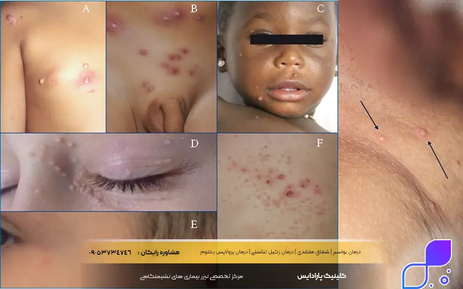 مولوسکوم تناسلی چیست؟