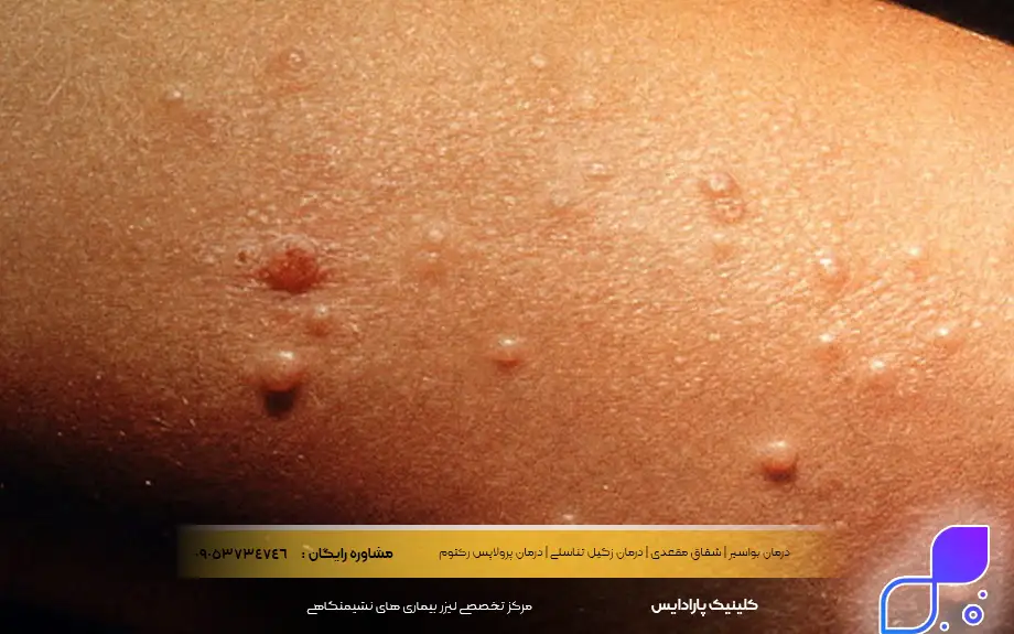 علائم مولوسکوم تناسلی