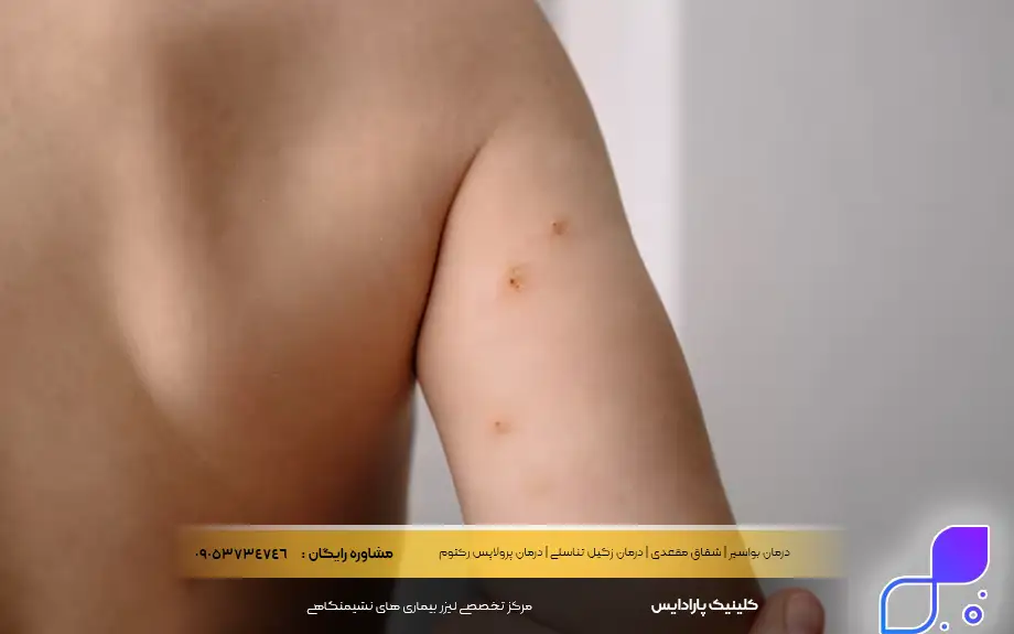 درمان قطعی مولوسکوم تناسلی