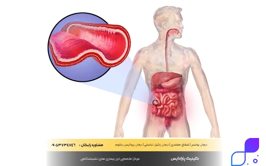 بیماری کرون چیست