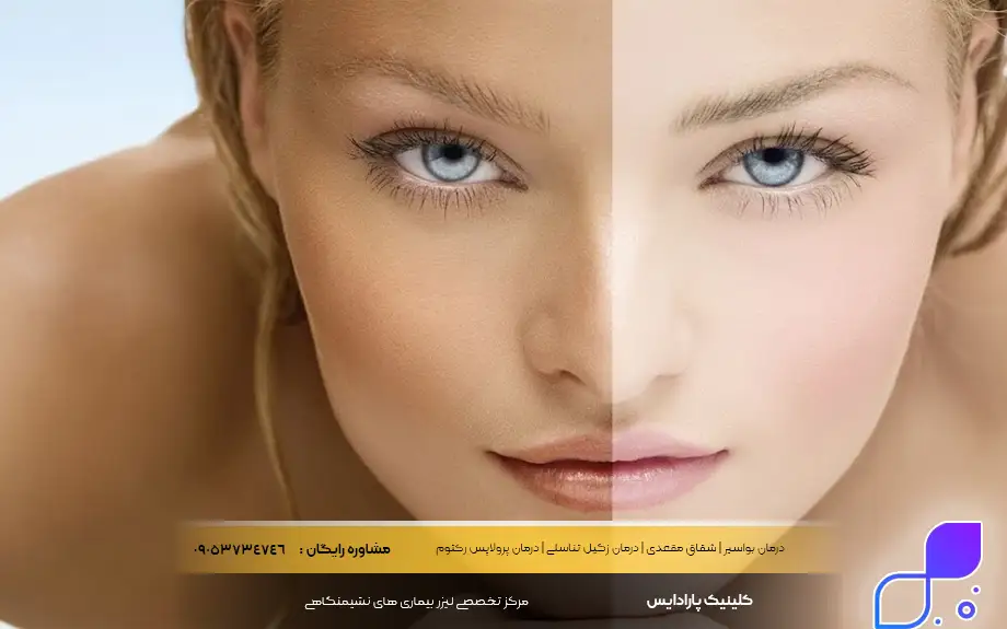 پماد بتامتازون برای سفیدی صورت