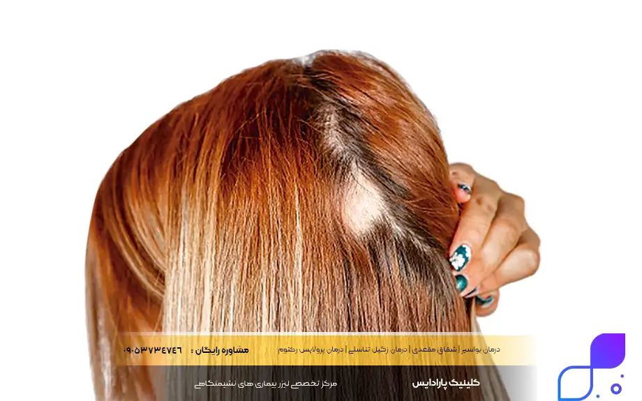 پماد بتامتازون برای ریزش سکه‌ای مو