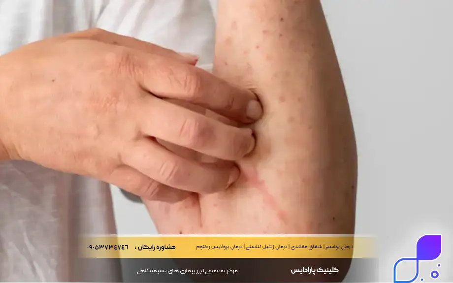 پماد بتامتازون برای قارچ پوستی