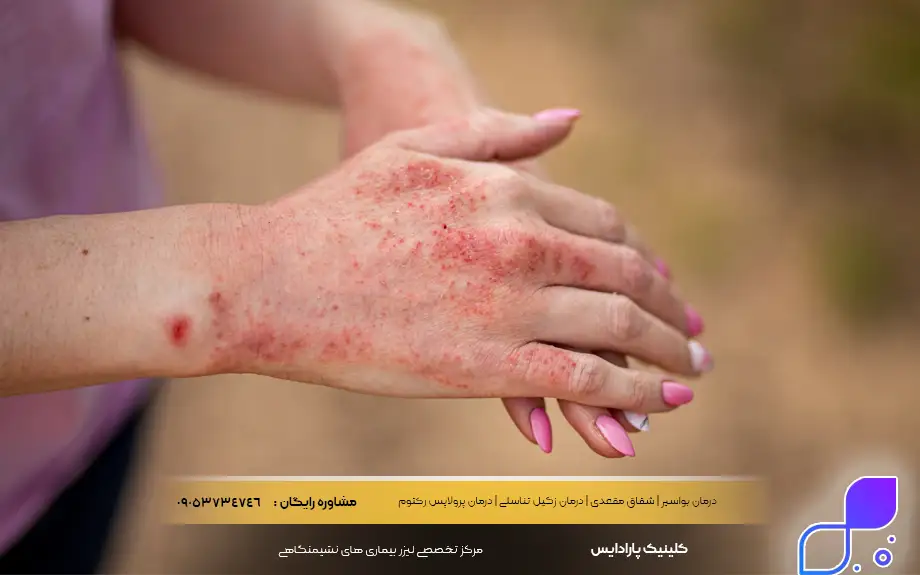 پماد بتامتازون برای اگزما