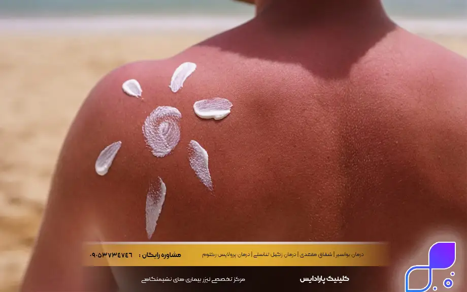 پماد بتامتازون برای سوختگی