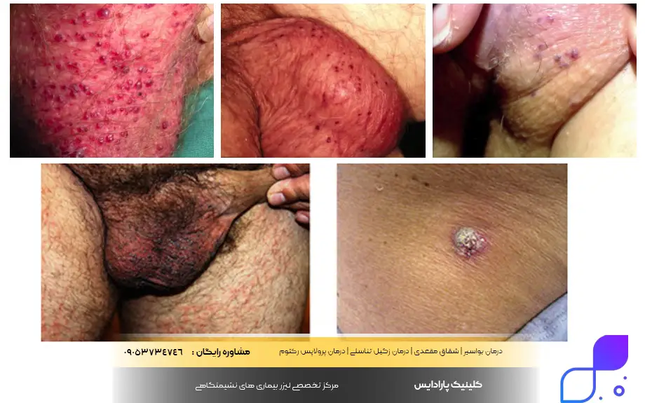 انواع آنژیوکراتوم