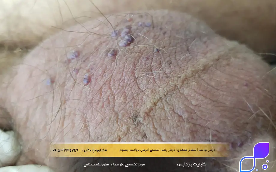 آنژیوکراتوم بیضه