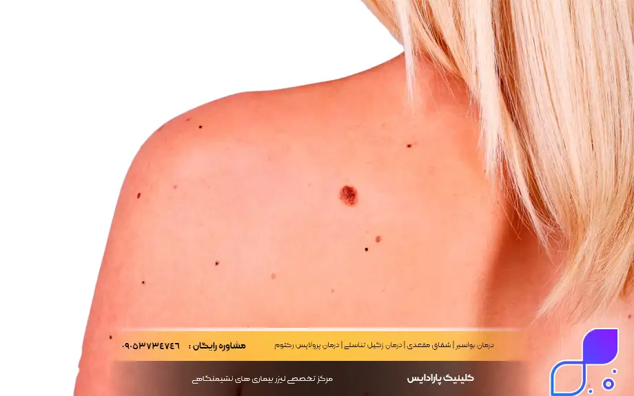 آنژیوکراتوم چیست