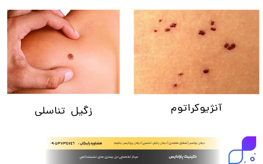 تفاوت آنژیوکراتوم با زگیل تناسلی