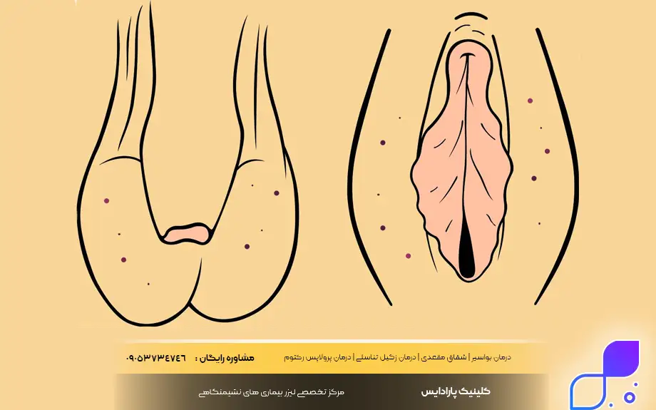 آنژیوکراتوم واژن