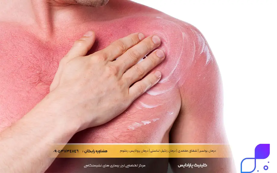 پماد کالاندولا برای سوختگی