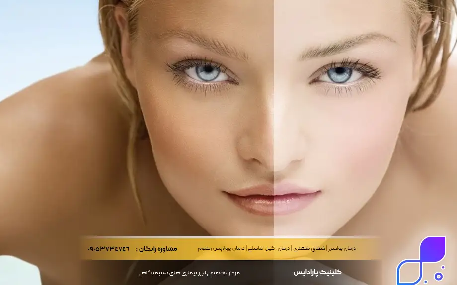 پماد کالاندولا برای سفیدی پوست