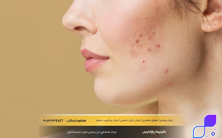 پماد کالاندولا برای جوش