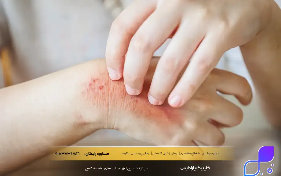 پماد کالاندولا برای عفونت قارچی