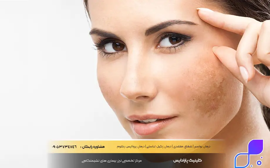 پماد کالاندولا برای لک صورت