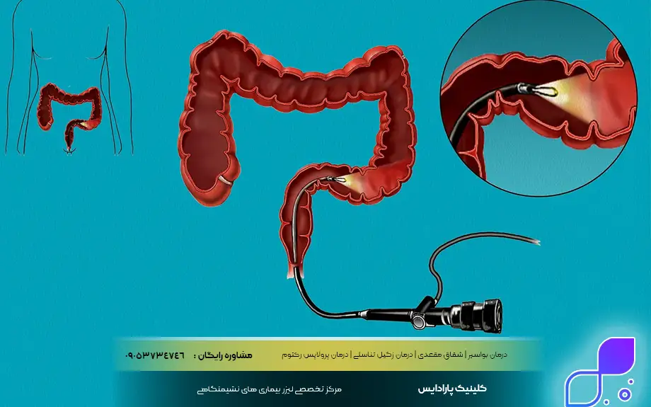 مراحل انجام آزمایش سیگموئیدوسکوپی