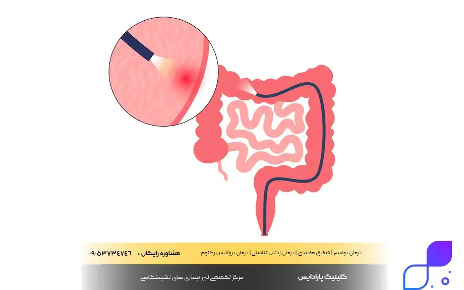 تفاوت سیگموئیدوسکوپی و کولونوسکوپی