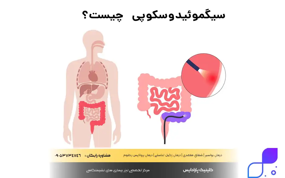 سیگموئیدوسکوپی چیست؟
