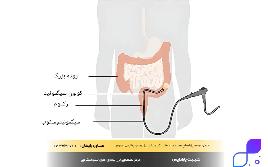 عوارض سیگموئیدوسکوپی