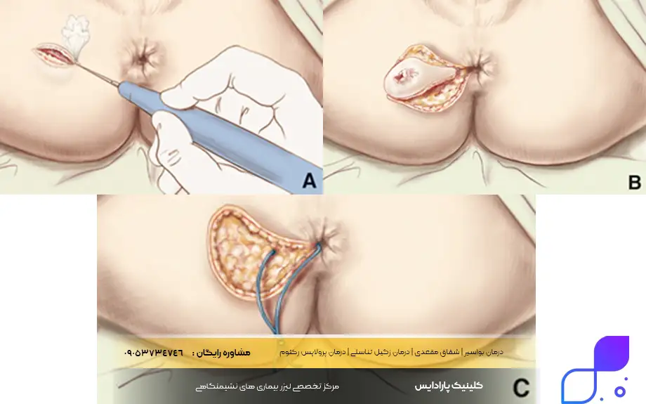 درمان ورم مقعدی