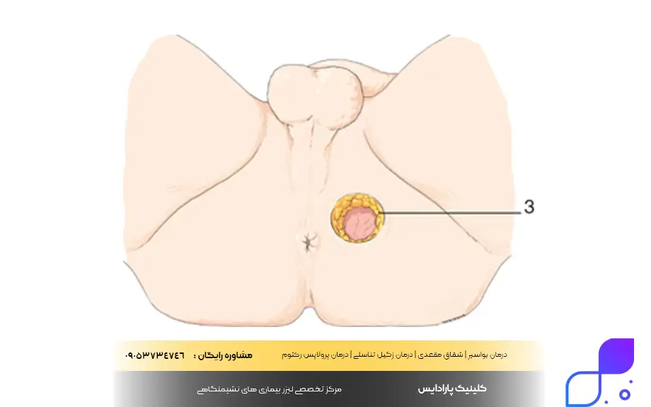 علائم ورم مقعد