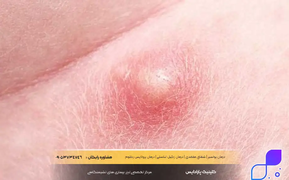 ورم مقعدی چیست؟