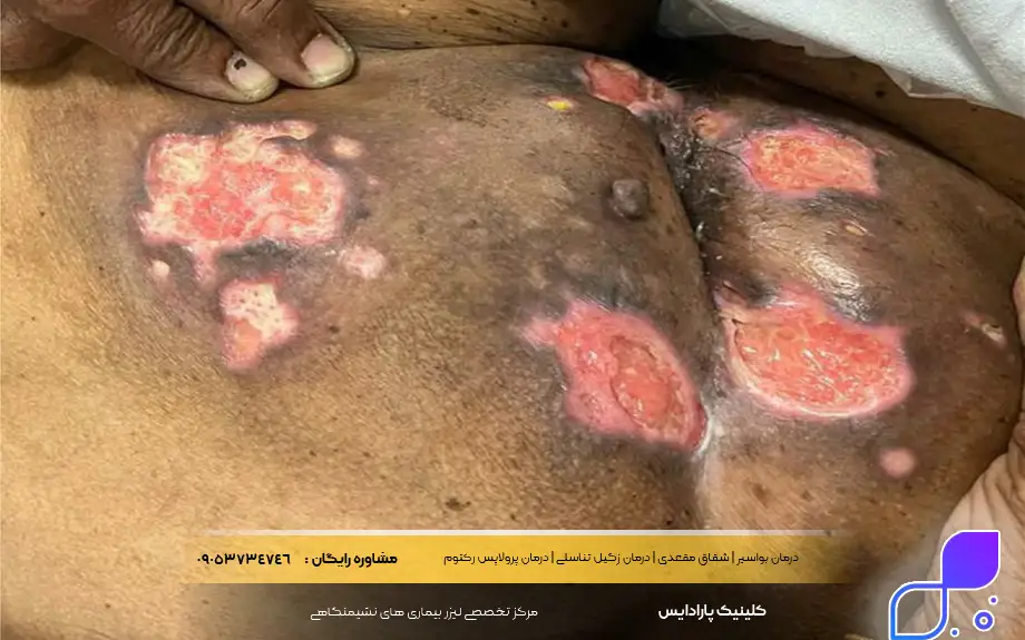 خطرات و عوارض جوش مقعد