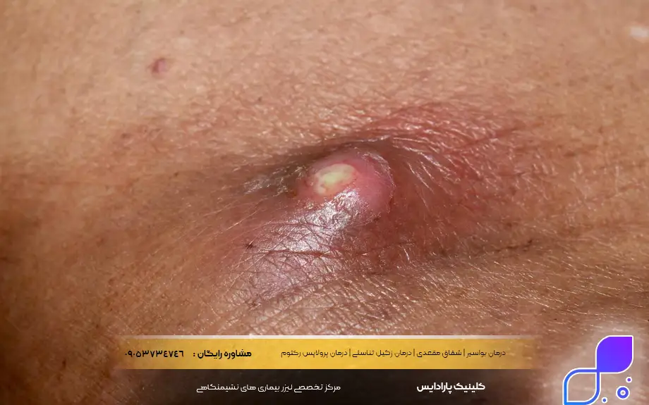 علائم جوش باسن
