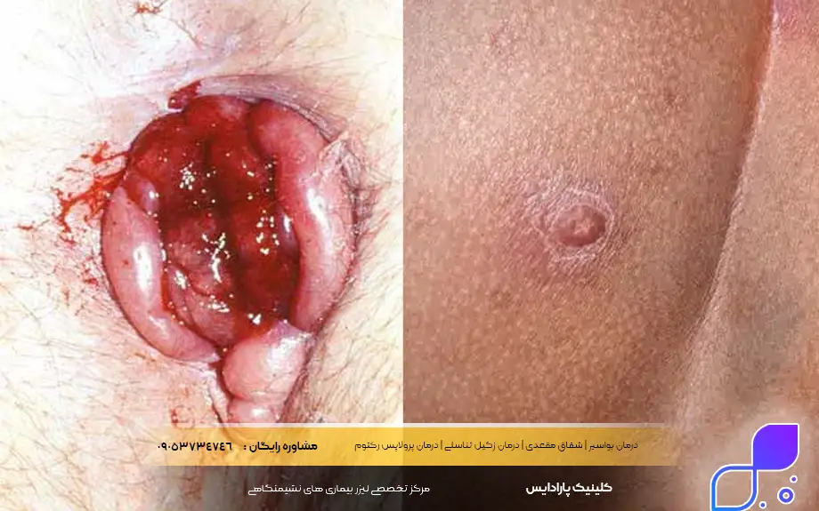 فرق جوش مقعدی با بواسیر