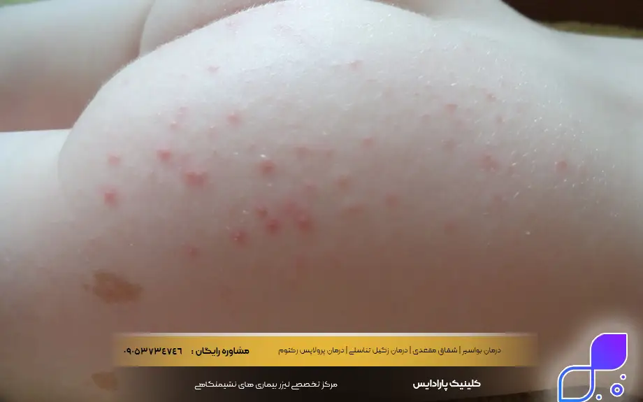 جوش مقعدی یا جوش آنال چیست