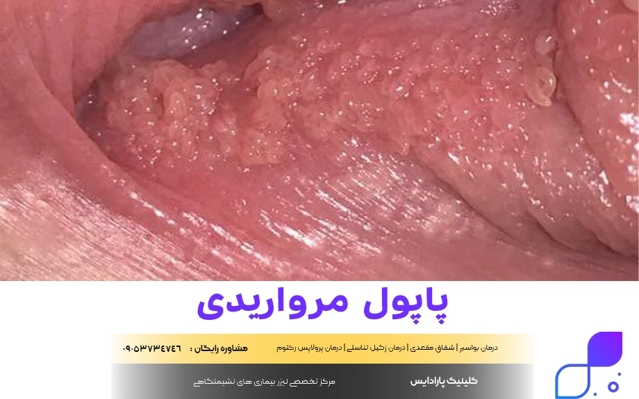 عکس وستیبولار پاپیلوماتوز + عکس پاپول مرواریدی زنانه