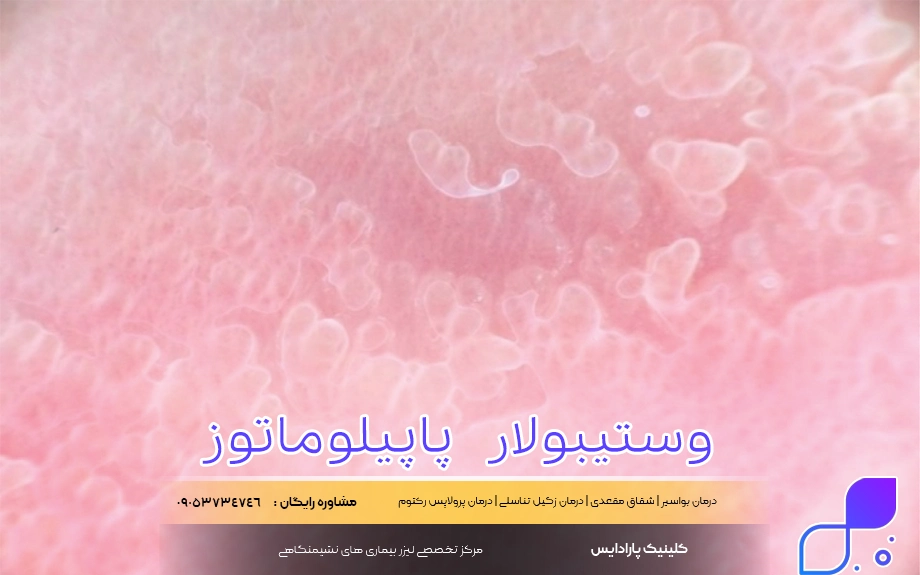 عکس وستیبولار پاپیلوماتوز در مردان