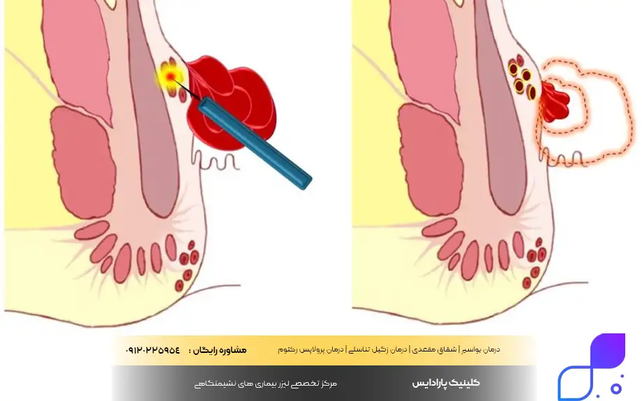 معجزه درمان هموروئید