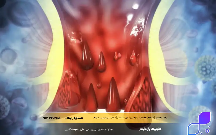 درمان بواسیر