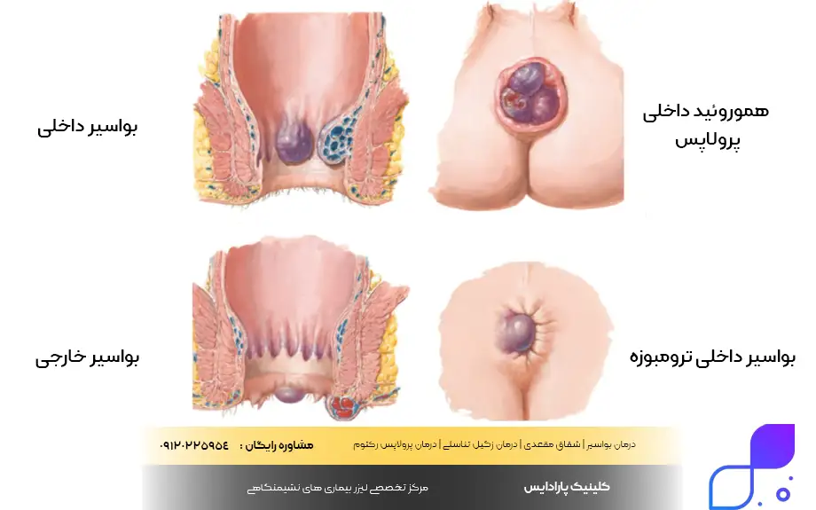 انواع بواسیر