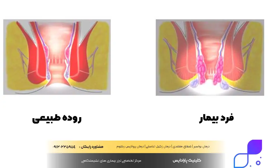 بواسیر چیست