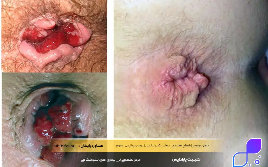 عکس بواسیر