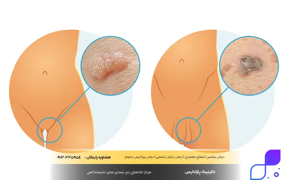 عکس واضح از زگیل تناسلی زنان