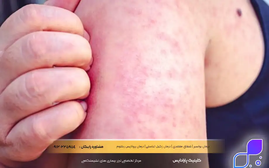 عوارض شیاف هیدروکورتیزون