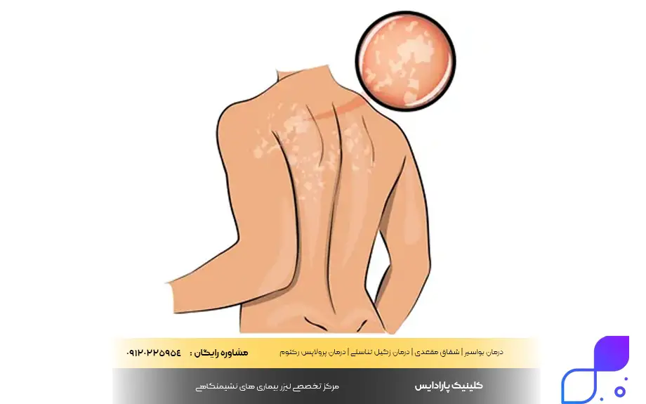 پماد هیدروکورتیزون برای قارچ پوستی