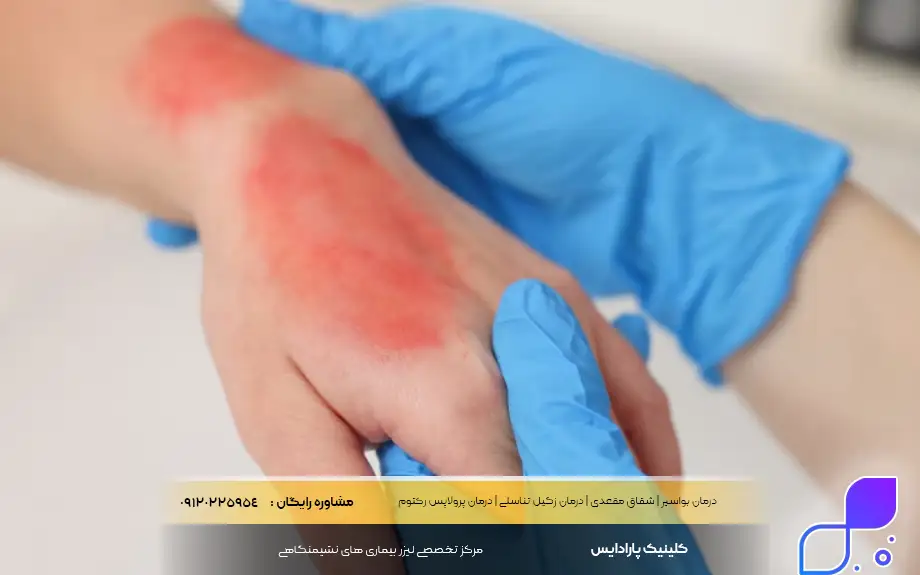 پماد تریامسینولون برای سوختگی