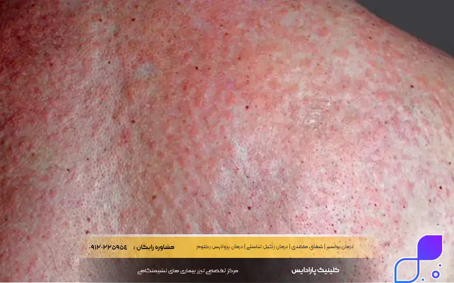 عوارض پماد کلوتریمازول