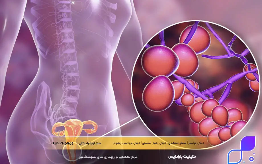 پماد کلوتریمازول برای عفونت واژن