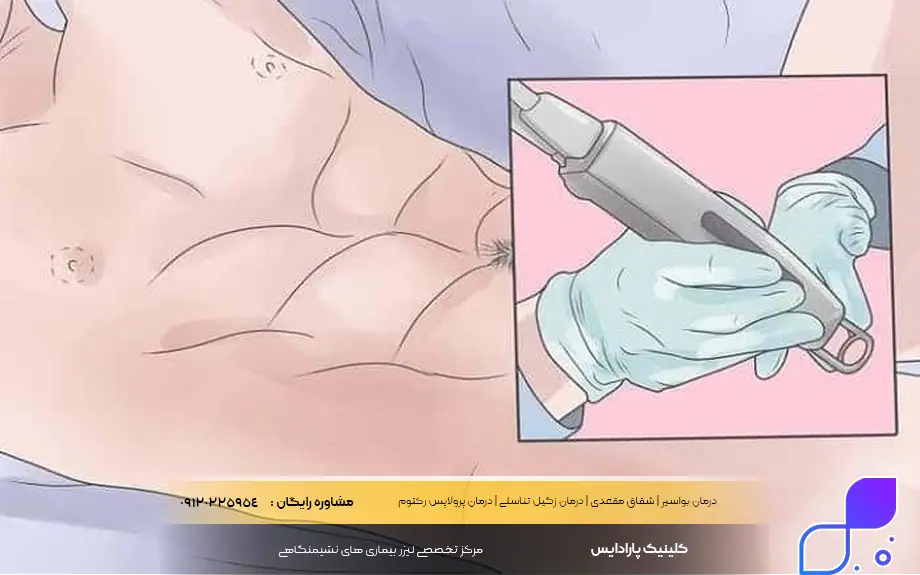 لیزر زگیل تناسلی