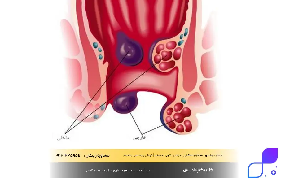 هموروئید ترومبوزه