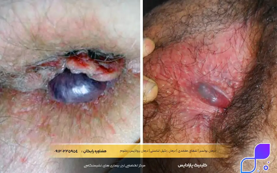 عکس بواسیر ترومبوزه