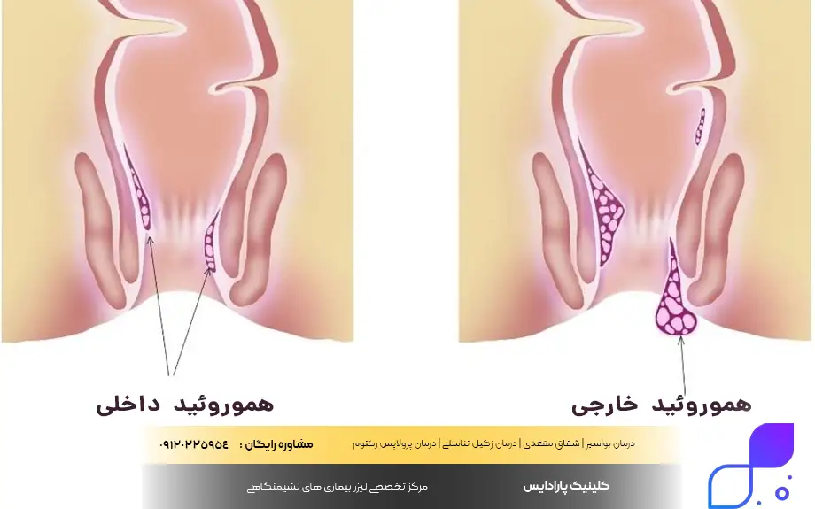 انواع هموروئید ترومبوزه